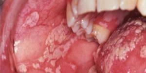 Por Que Se Me Hincha El Labio Superior De Repente Todas Las Causas