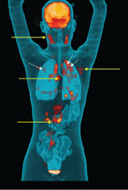 Image result for Extrapulmonary Tuberculosis