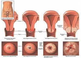 It is possible that the discharge may look yellowish, pale, or brownish, and it may contain some blood. Cervical Cancer Physiopedia