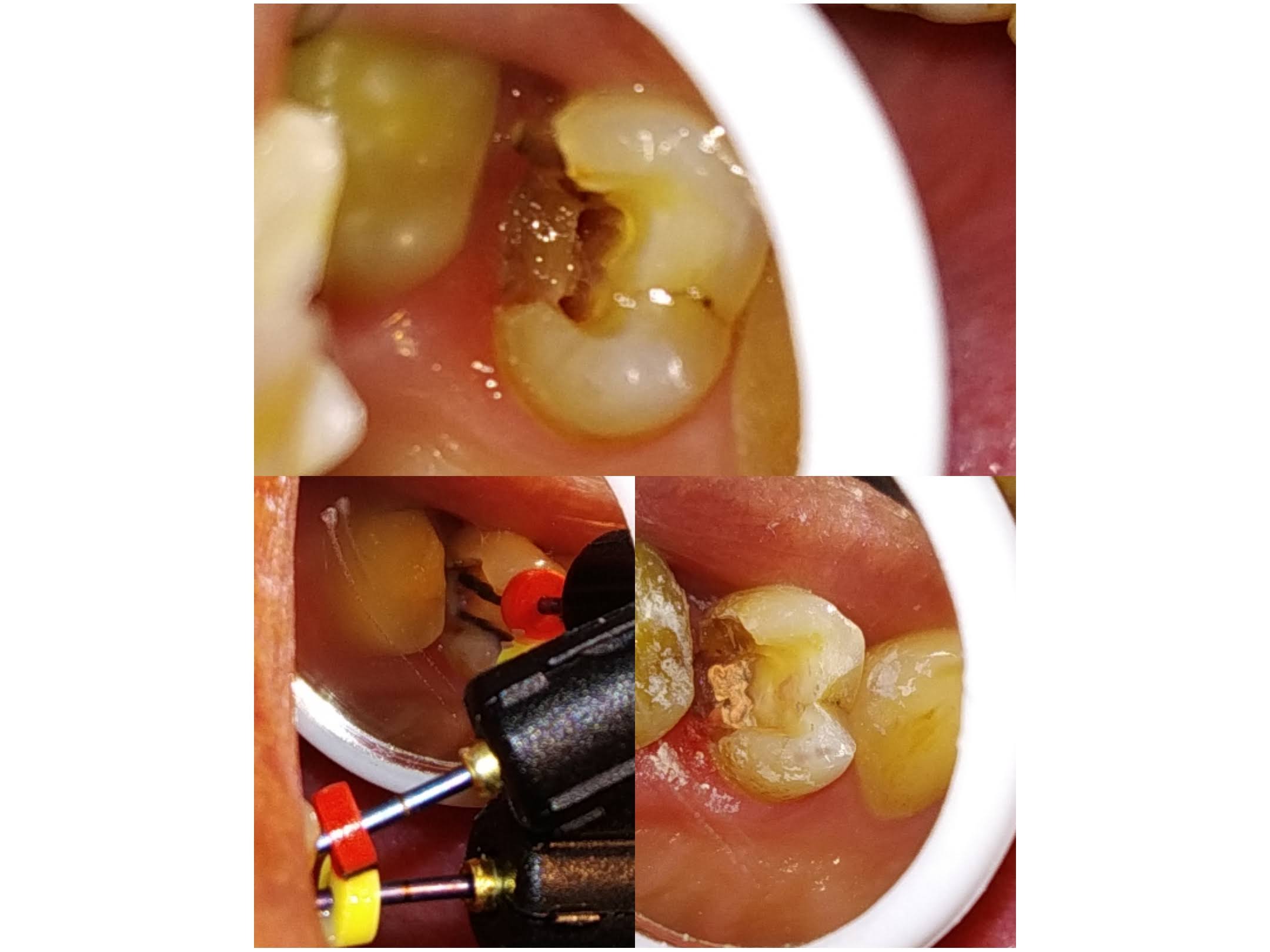 Root Canal Treatment product image