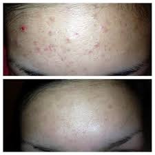 Neonatal acne is a benign skin condition that roughly 20 per cent of newborns have, explains katie pyle, do, a pediatrician at uchealth pediatric care clinic in firestone, colorado. Will Teen Acne Go Away On Its Own