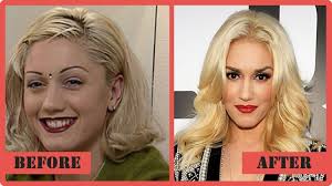 The voice star gwen stefani stunned fans with her youthful appearance on. Gwen Stefani Plastic Surgery Before And After Bad Plastic Surgery