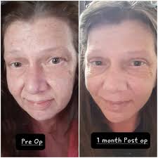 Hi, I am going to get blephs by oculoplastic surgeon and FL/NL by other  doctor. If anyone did like that separately, how far apart did you do? If  FL/NL first, the healing