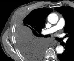 (ct), magnetic resonance (mr), positron . Ct Scan Image Showing Mesothelioma Eroding Through The Chest Wall Download Scientific Diagram