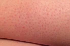 How To Get Rid Of Strawberry Legs Shareit Strawberry Legs Shaving Legs Shaving Tips