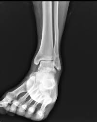 9 rupture of the atfl occurs as an isolated injury in 66% of all ruptures of the ankle. Lateral Ankle Ligament Sprain Radiology Case Radiopaedia Org