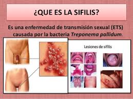 Resultado de imagen para sifilis