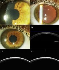 Professor Steven E. Wilson - Clearing The Haze: Understanding The Process  Of Scarring Following Corneal Injury • Scientia.Global