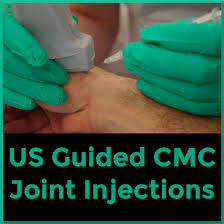 Performing an Ultrasound Guided Trapeziometacarpal Joint Injection - Sports  Medicine Review