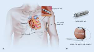 More advanced devices (icd, implantable cardioverter. The Modular Cardiac Rhythm Management System The Empower Leadless Pacemaker And The Emblem Subcutaneous Icd Springerlink