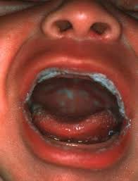Image result for Candidiasis