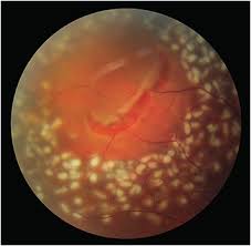 ↓ retinal tears ↓ retinal detachment is a serious eye emergency that involves the retina detaching or peeling. Retinal Physician Retinal Breaks Clinical Course And Outcomes After Retinopexy
