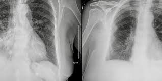 Check spelling or type a new query. What Is Pleural Mesothelioma Doc Dr Erkan Yildirim