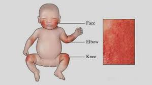 Image result for Impetigo