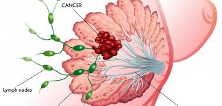 About 1 out of every 100 breast cancers diagnosed in the united states is ductal carcinoma in situ (dcis) is a breast disease that may lead to breast cancer. Lymphedema And Breast Cancer Diversified Integrated Sports Clinicdiversified Integrated Sports Clinic