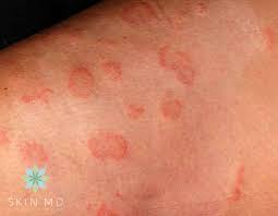 Sometimes itching with no rash can be the sign of a more serious medical problem. All You Need To Know About Skin Fungus Skin Md Dermatologist In Ortigas Pasig