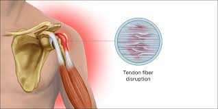 The subacromial bursa lies on the superior aspect of the supraspinatus tendon (see the images below). Mouse Shoulder A Painful Ailment For Pc Gamers Esports Healthcare