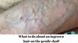 This ingrown hair occurs as a result of curling back of the hair tip, i.e., the hair grows into the skin. What To Do About An Ingrown Hair On The Penile Shaft Youtube