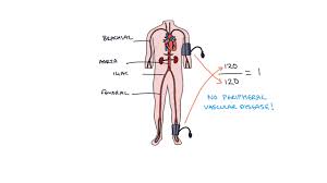 Understanding Ankle Brachial Pressure Index Abpi In Peripheral Vascular Disease