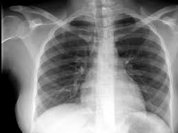 Lung Cancer Deaths Not Prevented By Routine X Rays Study Finds Cbs News