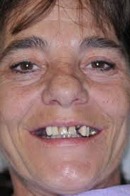 Dental Implants Las Vegas