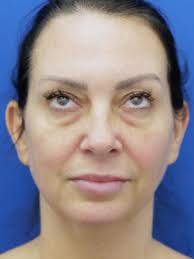 Lower Eyelid Skin Laxity 3042