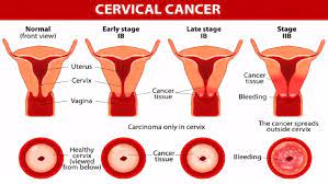 If you have uterine cancer, you will. Everything You Need To Know About Cervical Cancer Health Guide 911