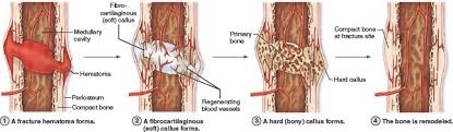 7 17 Fracture Repair Bone Fracture Repair Fracture