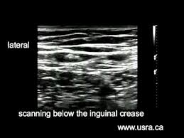 Lateral femoral cutaneous nerve ultrasound. Lateral Femoral Cutaneous Nerve Block Scanning The Lateral Femoral Cutaneous Nerve Youtube