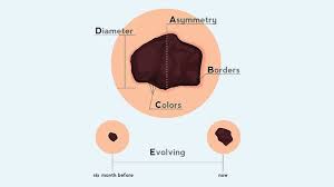 Melanoma is one of the most serious forms of skin cancer.in early stages, it may be treated through relatively simple surgery, but advanced stages can be lethal. Spotting Early Signs Of Melanoma Everyday Health