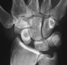 Image result for Scapholunate Dislocation