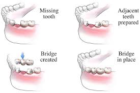 Dental Bridge Procedure Healthdirect