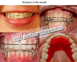 Orthodontic Retainers Great Tools In Dentistry Orthodontics Registered Dental Hygienist Dentistry