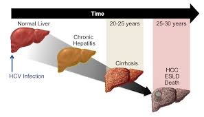 Core Concepts Natural History Of Hcv Infection Evaluation Staging And Monitoring Of Chronic Hepatitis C Hepatitis C Online