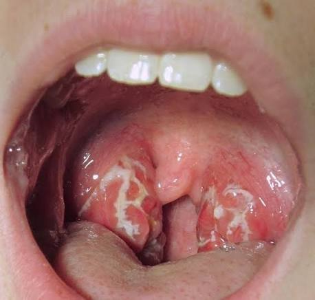 Những điều cần biết về bệnh viêm họng có mủ - Nhà thuốc FPT Long Châu