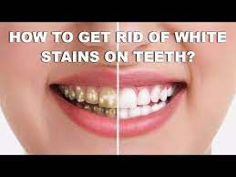 Pin On White Teeth Quickly Easily