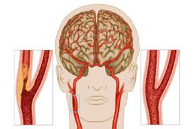 It supplies structures present in the cranial cavity and orbit. Carotid Artery Disease Symptoms Treatment Mount Elizabeth Hospitals