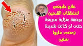و في هؤﻻء غالبا ما يكون مرض دوالي الساقين مصحوبا. ÙƒÙ†Ø² Ø¬Ø¹Ù„Ù‡ Ø§Ù„Ù„Ù‡ Ø¹Ù„Ø§Ø¬ Ø¯ÙˆØ§Ù„ÙŠ Ø§Ù„Ø³Ø§Ù‚ÙŠÙ† ÙˆÙŠØ´ÙÙŠ Ø¨Ø³Ø±Ø¹Ø© Ø·Ø±Ù‚ Ø·Ø¨ÙŠØ¹ÙŠØ© Ù„Ù…Ø­Ø§Ø±Ø¨Ø© Ø§Ù„Ø£ÙˆØ±Ø¯Ø© Ø§Ù„Ø¹Ù†ÙƒØ¨ÙˆØªÙŠØ© ÙˆØ¯ÙˆØ§Ù„ÙŠ Ø§Ù„Ø³Ø§Ù‚ÙŠÙ† Youtube