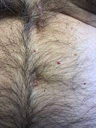 In patients with liver disease, your liver can't metabolize estrogen, so the level is higher in for example, if you have one on your scalp that makes hair brushing a nuisance or one on your waist that your pants rub against. Bright Red Dome Shaped Papules Clinical Advisor