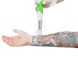 How Many Sessions Of Laser Tattoo Removal Will I Need