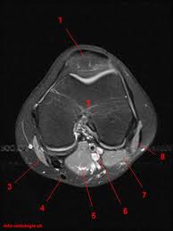 This webpage presents the anatomical structures found on knee mri. Mrt Der Knie T2 Gewichtete Fatsat Axialen Schnitte