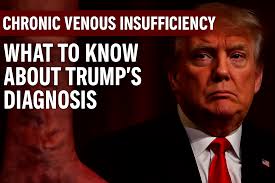 Trump's Chronic Venous Insufficiency Explained