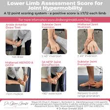 Image result for Hypermobility Signs