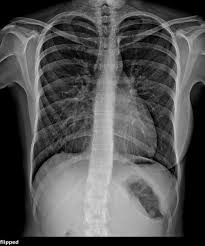 Image result for Pectus Excavatum