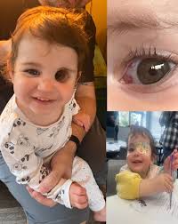 One of the most successful surgeries in the world ❤️ This beautiful girl is  pictured after a life-changing surgical repair of a bilateral cleft lip and  palate. In this condition, the muscle