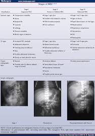 Image result for Necrotizing Enterocolitis
