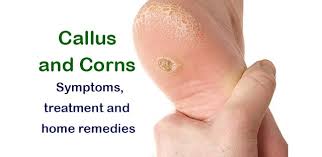 Soak your feet in apple cider vinegar. Corns And Foot Calluses Symptoms Treatment And Home Remedies