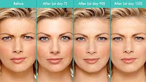 How soon does dysport start to work? Wrinkle Smoothing Dysport In Austin Tx Aesthetica Med Spa