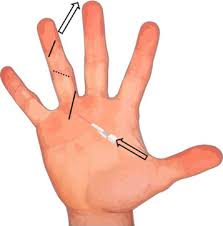 Image result for phlegmon of hand)