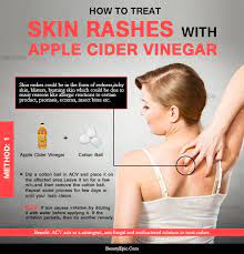 How To Use Apple Cider Vinegar For Skin Rash